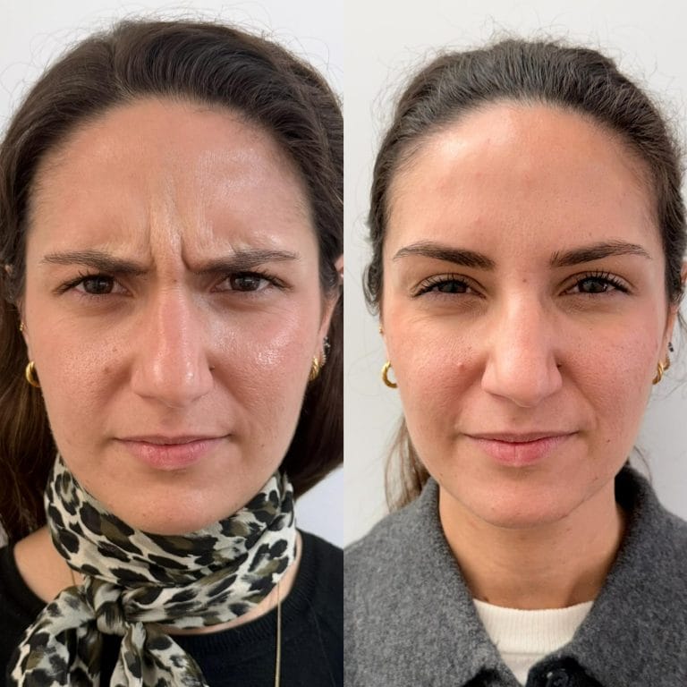 Detalle de una mirada vital y descansada tras la aplicacion de neuromoduladores en Clinica Eterea Valencia.