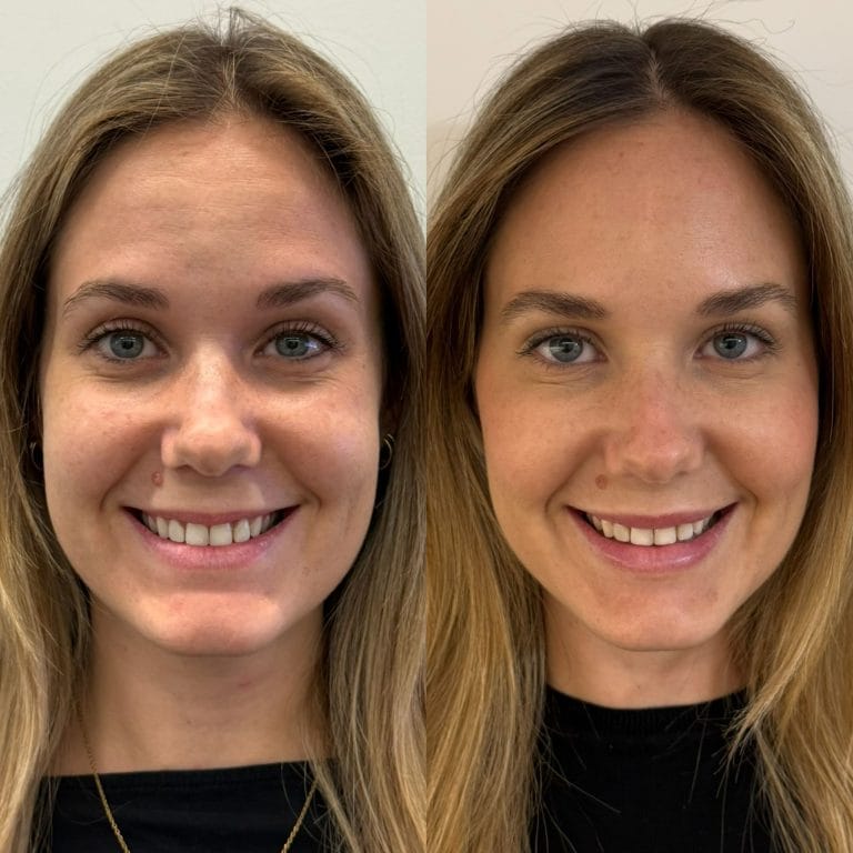 Primer plano que muestra la zona lateral de los ojos con la piel lisa y joven tras el tratamiento en Clinica Eterea Valencia.