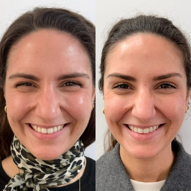 Resultado de una sonrisa con el contorno de ojos libre de arrugas profundas tras pasar por Clinica Eterea Valencia.