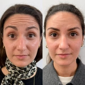 Resultados definitivos del tratamiento de neuromoduladores en el tercio superior realizado por expertos en Valencia.