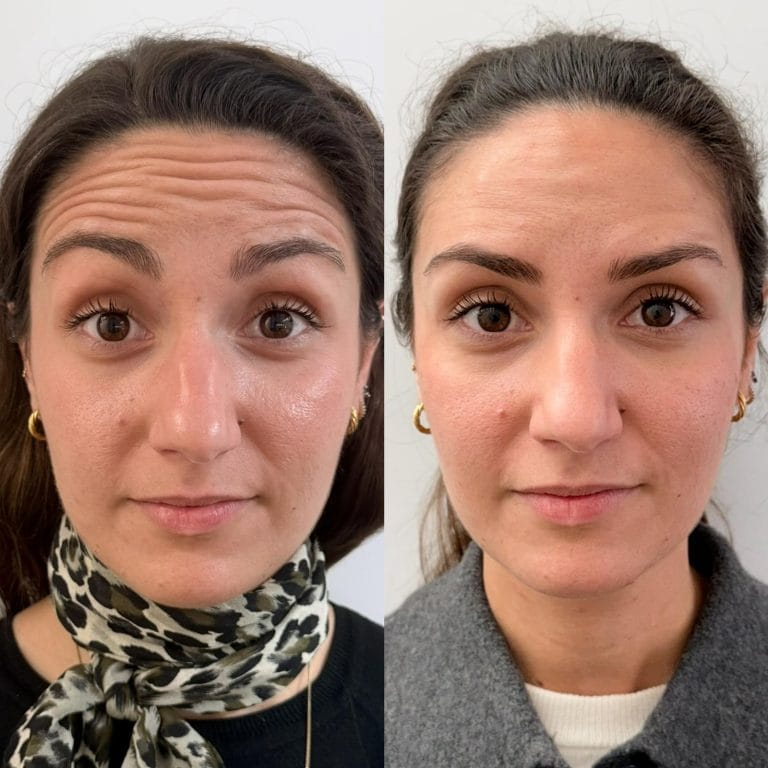 Resultados definitivos del tratamiento de neuromoduladores en el tercio superior realizado por expertos en Valencia.