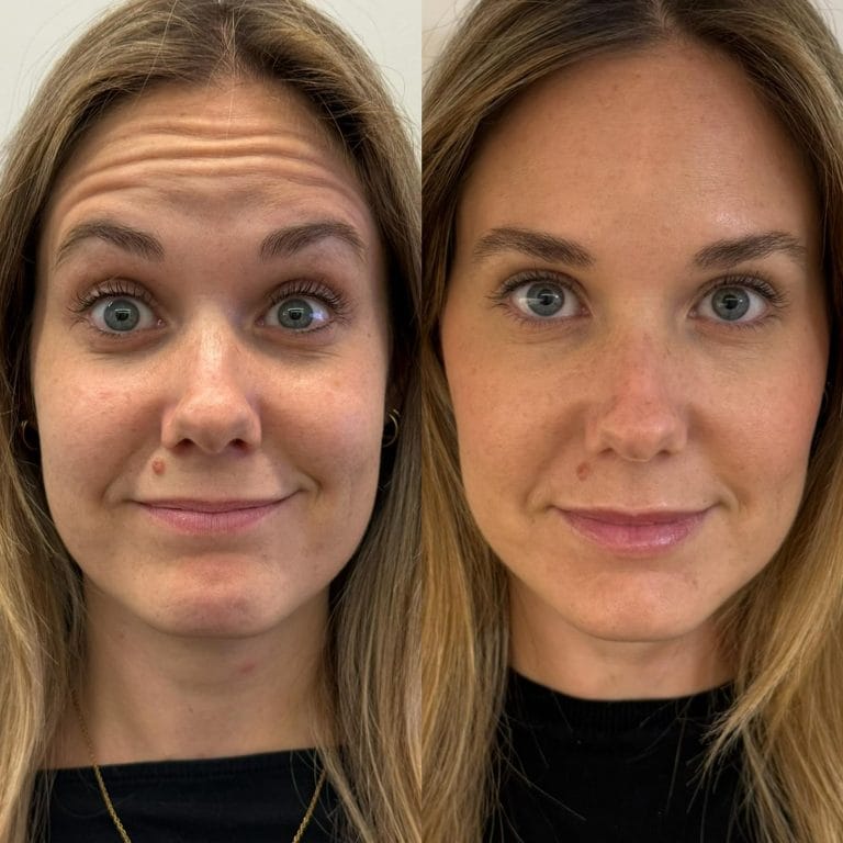 Piel de la frente con aspecto saludable y sin lineas de expresion profundas tras visitar Clinica Eterea Valencia.