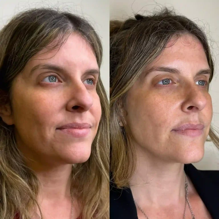 Resultado lateral de tratamiento Full Face Armonización Facial destacando la definición del óvalo. Perfilado facial y tratamiento de luminosidad en paciente femenina joven.