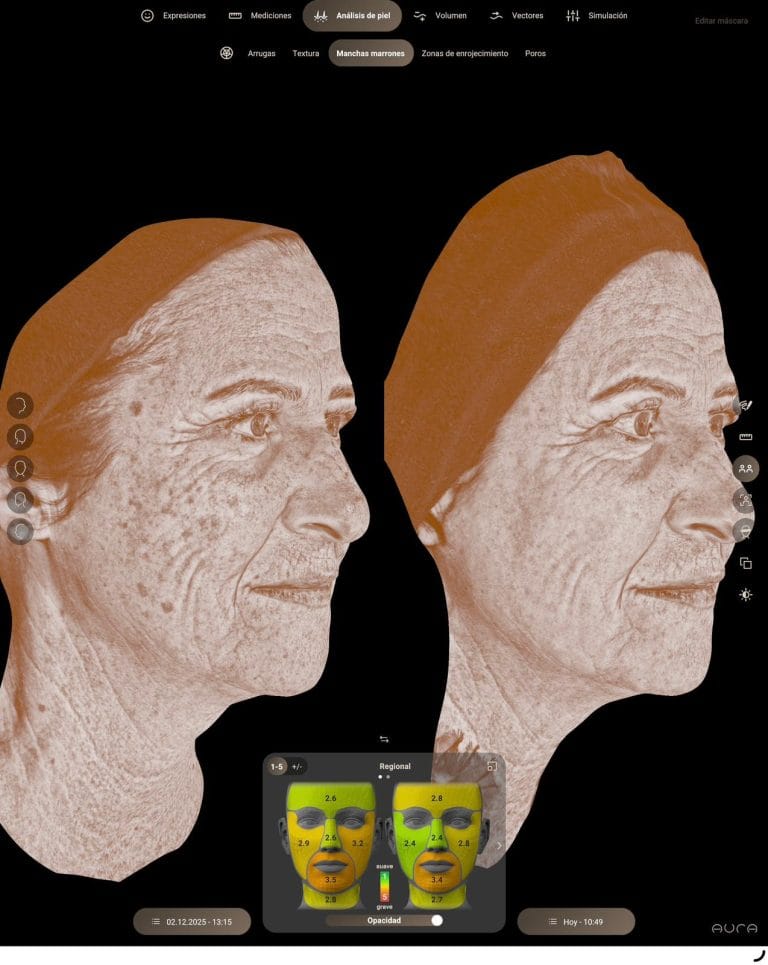 Proceso de borrado de manchas con Laser Ablativo en Clinica Eterea Valencia.