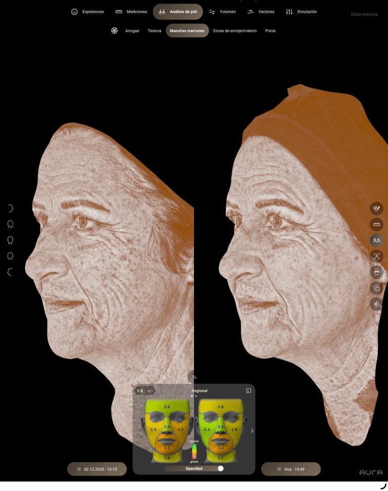 Resultado de eliminacion de manchas con Laser IPL en Clinica Eterea Valencia.