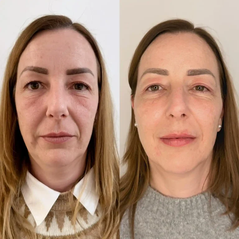 Detalle frontal del tratamiento de rejuvenecimiento facial enfocado en la zona peribucal y óvalo. Vista frontal de mujer madura tras tratamiento de arrugas y flacidez facial en Clínica Etérea.