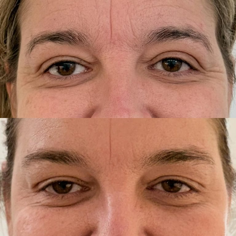 Detalle de los resultados del tratamiento para arrugas en los ojos o patas de gallo en Clinica Eterea Valencia.