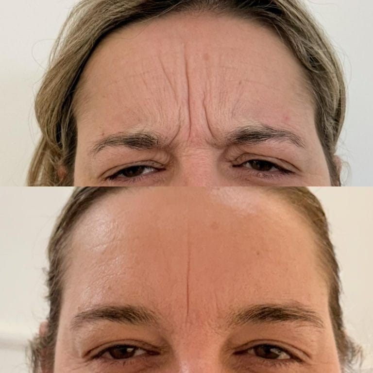 Resultado de un entrecejo libre de arrugas verticales tras el tratamiento con neuromoduladores en Valencia.