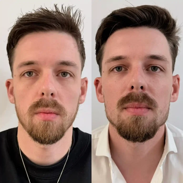 Resultado frontal de armonización facial masculina buscando simetría y fuerza. Rostro masculino de frente tras tratamiento de proyección y armonización facial en Clínica Etérea.