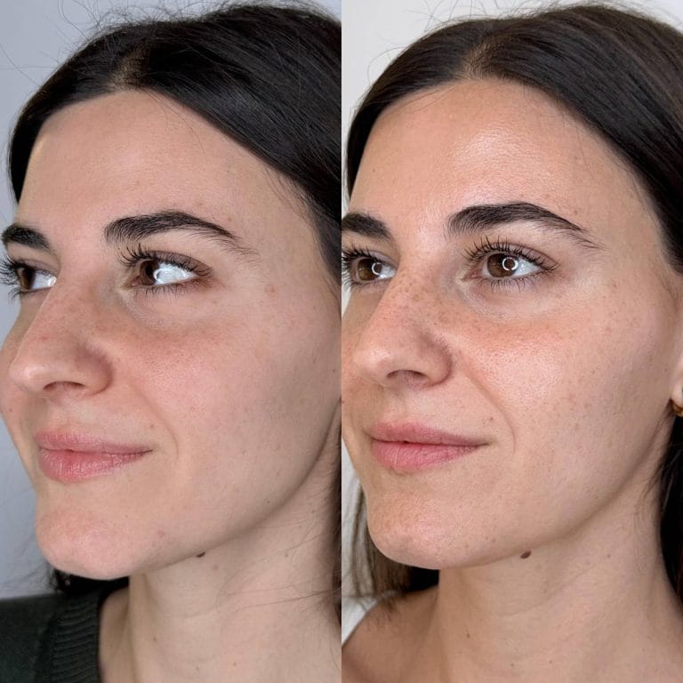 Antes y después de inductores de colágeno Collagen Banking en Clínica Etérea Valencia mejora de luminosidad y textura facial