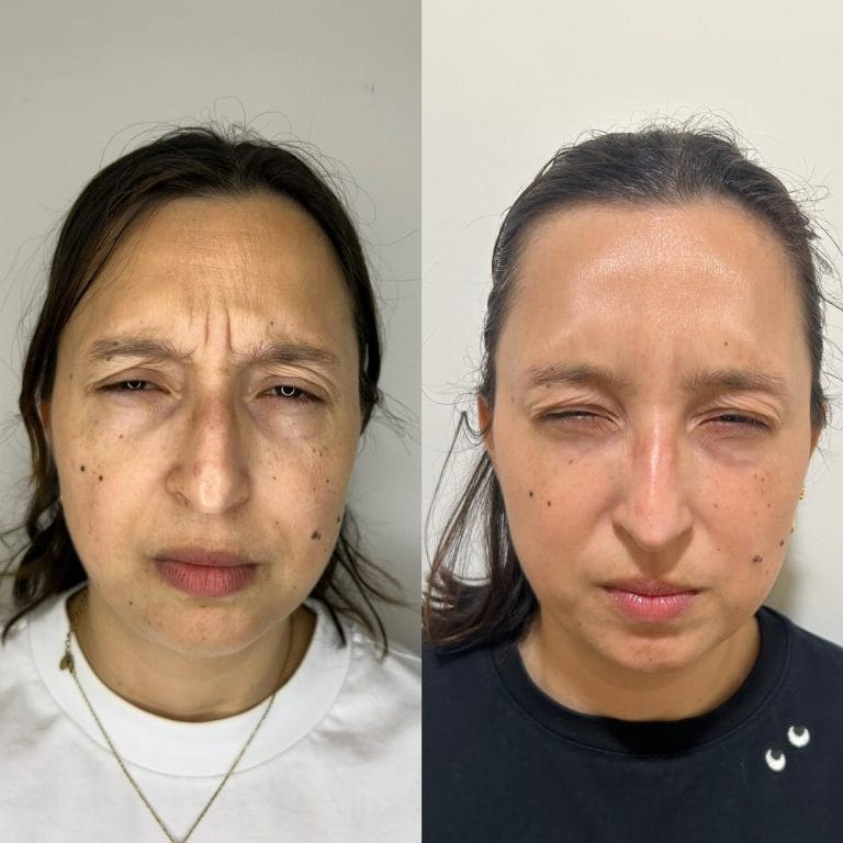 Antes y despues Collagen Banking entrecejo Valencia