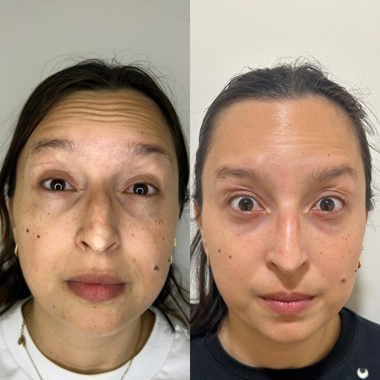 Antes y despues Collagen Banking frente Valencia