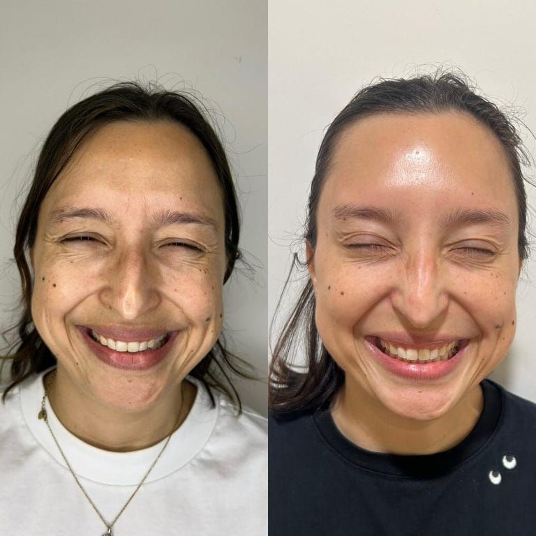 Antes y despues Collagen Banking lineas de expresion patas de gallo Valencia