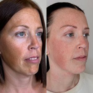 Tratamientos de medicina estética en verano