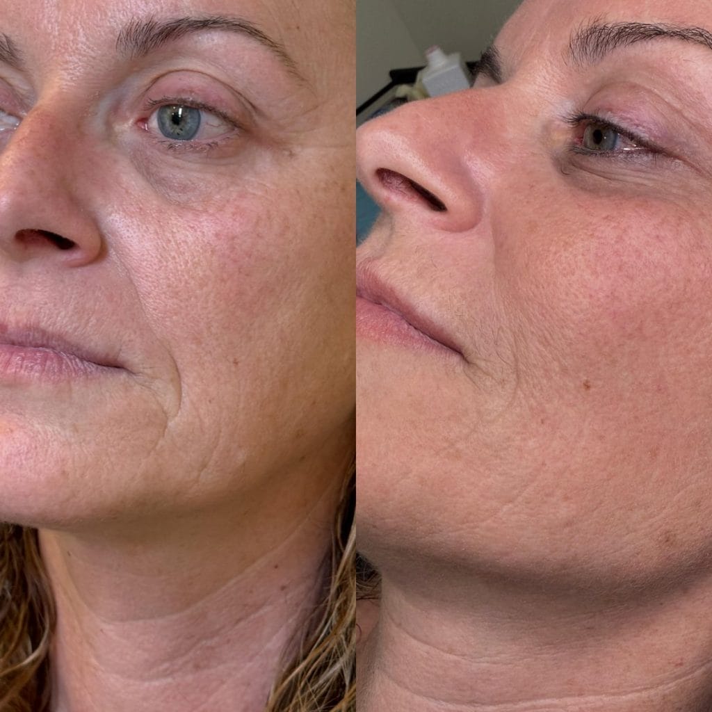 Tratamiento Láser Facial Clear Lift. Rejuvenecimiento Facial sin cirugía.