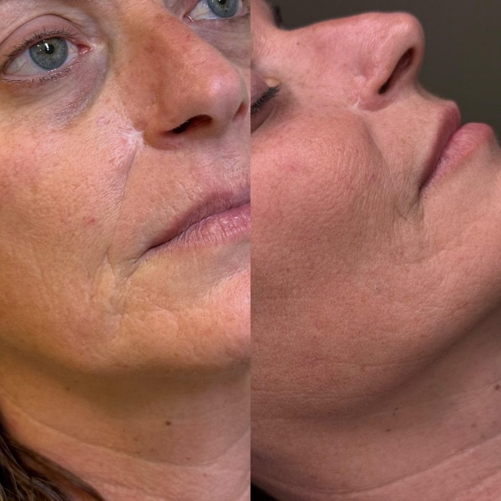 Tratamiento Láser Facial Clear Lift Rejuvenecimiento Facial sin cirugía.
